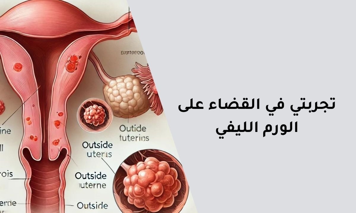 تجربتي في القضاء على الورم الليفي