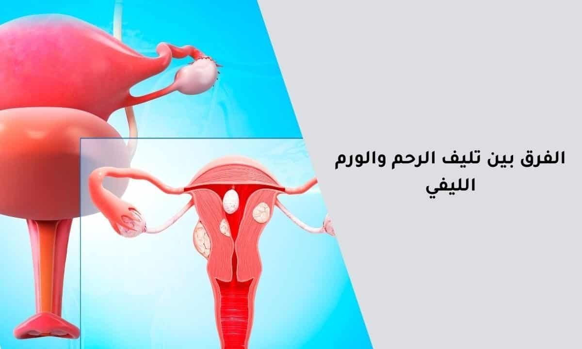 اعرفي الفرق بين تليف الرحم والورم الليفي الآن