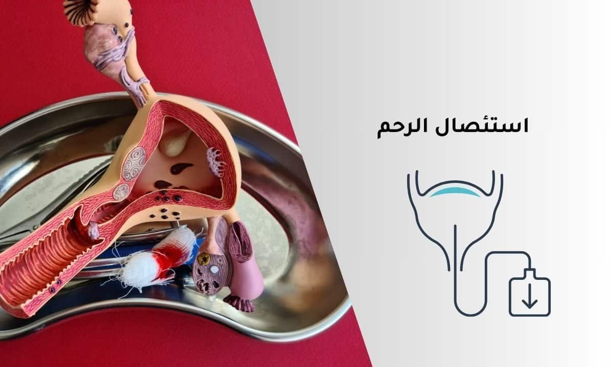استئصال الرحم: كل ما تحتاجين معرفته عن العملية وأسبابها