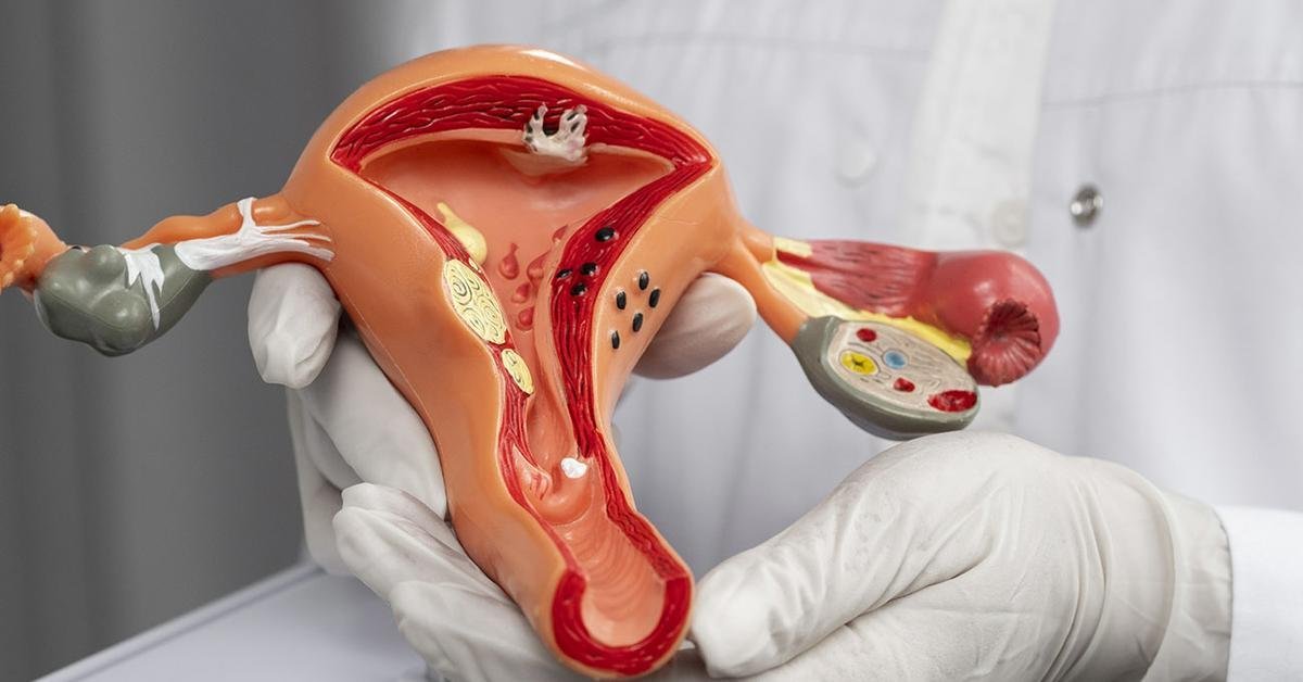 الياف الرحم هل هي خطيرة؟