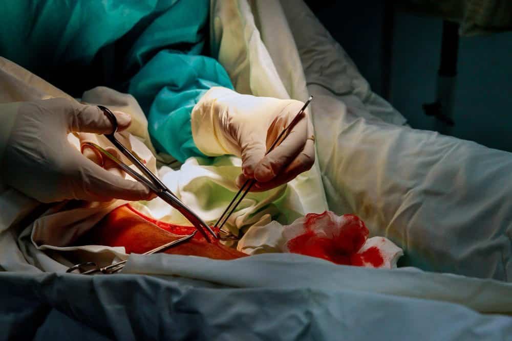 هل عملية استئصال الورم الليفي خطيرة؟