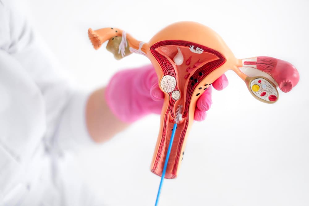 قسطرة الرحم للأورام الليفية: علاج تليف الرحم بدون جراحة
