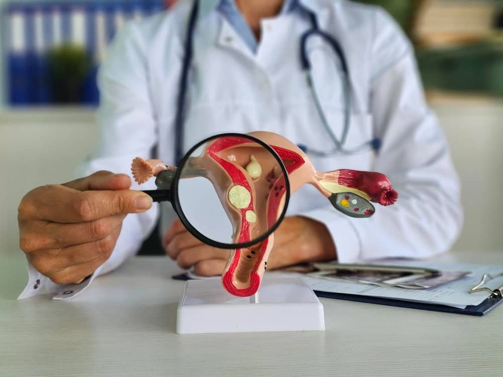 Treatment of Fibroids Without Surgery: A Safe Path to Recovery 2 Best Treatment for Large Fibroids