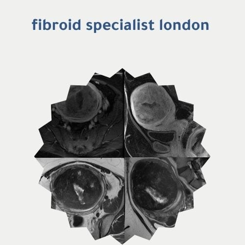 Fibroid Specialist London