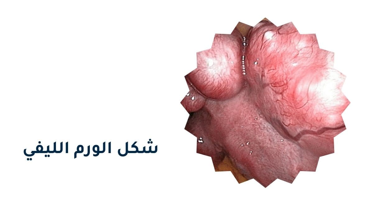 كيف يكون شكل الورم الليفي في الرحم